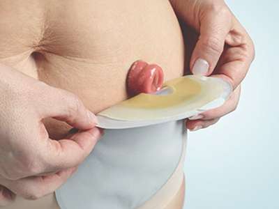 Ostomia