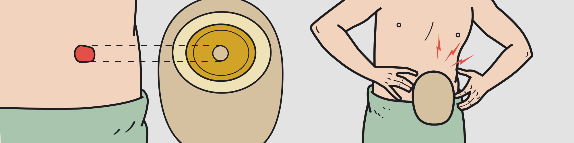 importaciones quirurgicas, iq, colostomia, ostomia, chile, oftalmología, especialidades medicas, coloplast, estoma, placa, disco, convexo, swiss roll convexo, swiss roll plano, disco ostomia extra adhesivo, 40mm, 60mm, plano, dioptria, urostomia, ileostomia, drenable, transparente, opaca, bolsa, operatorio, urologia, continencia, pediatrica, hidrocoloide, hidrogel, swiss roll, protector cutaneo, fistula, sonda prostatica, prótesis peneana, cateter, estuche peneal, tapon anal, toallita protectora, santiago, chile, las condes, insumos medicos, insumos para operación, herida, tratamiento para heridas, lente intraocular, ipcl, Implantable Phakic Contact Lens, Alta dioptria, presbyoptic, presbioptico, Toric, torico, torico alta dioptria, genesis prótesis peneana maleable, prótesis peneana maleable, catéter perrcutaneo, sonda prostatica, sonda prostatica couvelaire balon, guia dormia no tip, guía catéter doble j, balón de dilatación, estuche penal, toallita protectora conveen, easicath, cateter con revestimiento hidrofilico, catéter lubricado, barreras para colostomia, barreras de colostomia, base para colostomia, bolsa colostomia 2 piezas, bolsa convexa para colostomia, bolsa convexa para ileostomia, bolsa de colostomia 2 piezas, bolsa de colostomia 2 piezas, bolsa de colostomia con base, bolsa de colostomia con drenaje, bolsa de colostomia con filtro, bolsa de colostomia con placa, bolsa de colostomia de dos piezas, bolsa de colostomia de una pieza, bolsa de colostomia dos piezas, bolsa de colostomia llena, bolsa de colostomia para adulto, bolsa de colostomia pediatrica, bolsa de colostomia precio, bolsa de drenaje de colostomia, bolsa de ostomia, bolsa de ostomía abierta, bolsa de ostomía, bolsa de ostomia de dos piezas, bolsa de ostomia de una pieza, bolsa drenable para ostomia, bolsa ileostomia, bolsa ostomia, bolsa para colostomia, bolsa para colostomia pediatrica, bolsa para ostomia, bolsa para urostomia, bolsas colostomia, bolsas colostomia para bebes, bolsas colostomía, bolsas colostomia pediatricas, bolsas de colostomia, bolsas de colostomia convexas, bolsas de colostomia infantil, bolsas de colostomia para bebe, bolsas de ileostomia, bolsas de ostomia tipos, bolsas para colostomia con filtro, bolsas para colostomia pediatrica, bolsas para estomas, bolsas para ileostomia, bolsas y barreras para colostomia, bolsita de colostomia, colocación de bolsa de colostomia, colostomia bolsa, colostomia bolsa llena, colostomia ileostomia, colostomia ostomia, colostomia y ileostomia, colostomia y urostomia, desodorante para bolsas colostomia, disco colostomia, disco de colostomia, dispositivo de ostomia, dispositivos para ostomias, drenaje colostomia, drenaje de bolsa de colostomia, drenaje de colostomia, equipo para colostomía, estoma urostomia, hollister colostomia, ileostomia bolsa, ostomia colostomia, para que se usa la bolsa de colostomia, parche colostomia, placa colostomia, placa colostomia convexa, placa convexa ostomia, placa de ostomia, placa ostomia, placa para colostomia, poner bolsa de colostomia, productos de colostomia, tipo de bolsas de colostomia, tipos de bolsa colostomia, tipos de bolsa para colostomia, tipos de bolsas de ostomia, tipos de bolsas para colostomia, Santiago, Las Condes, Chile, Valparaiso, Concepcion, Talca, Puerto Varas, Puerto Montt, Punta Arenas, Viña del Mar, La Serena, Iquique, Antofagasta