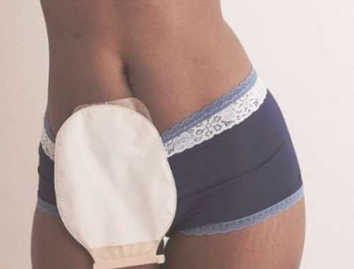 Importaciones-Quirurgicas-Foto-Articulos-Ostomia